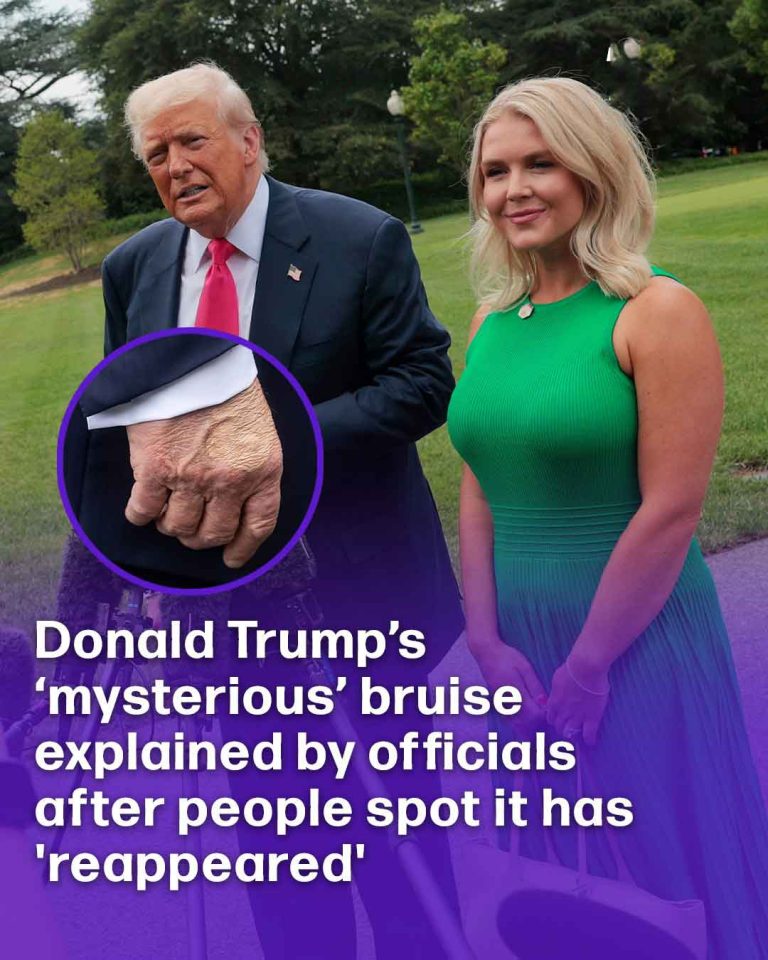Donald Trump’s ‘mysterious’ bruise explained by officials after people spot it has ‘reappeared’