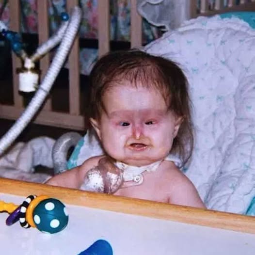 Unusual Syndrome at Birth: 22 Years Later,