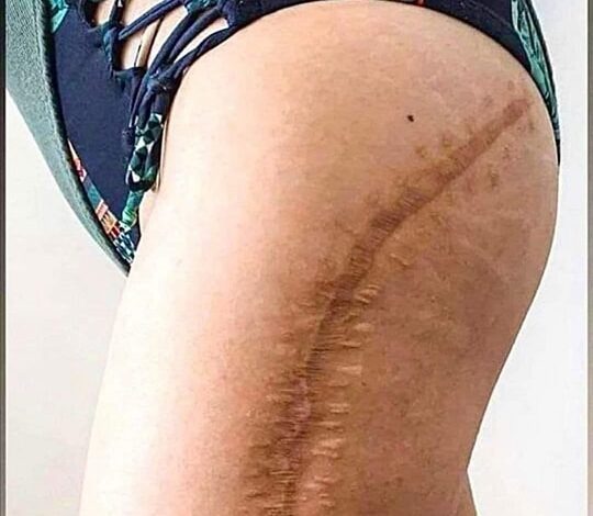 Tattoos can help you turn scars into something beautiful