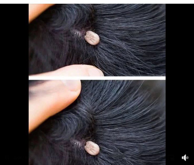 Just Discovered This in My Son’s Hair — What Is It?