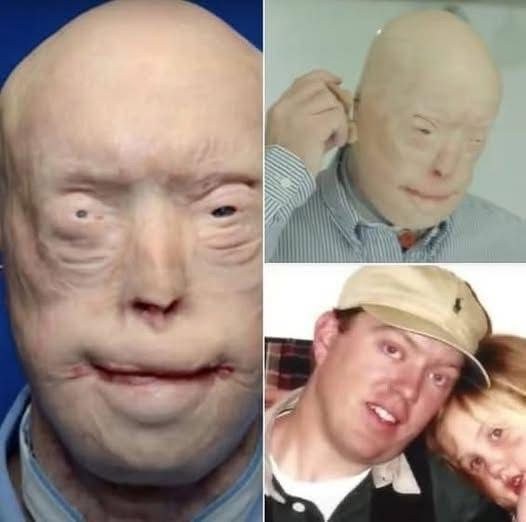 Firefighter suffers third-degree burns, this is him 7 years later