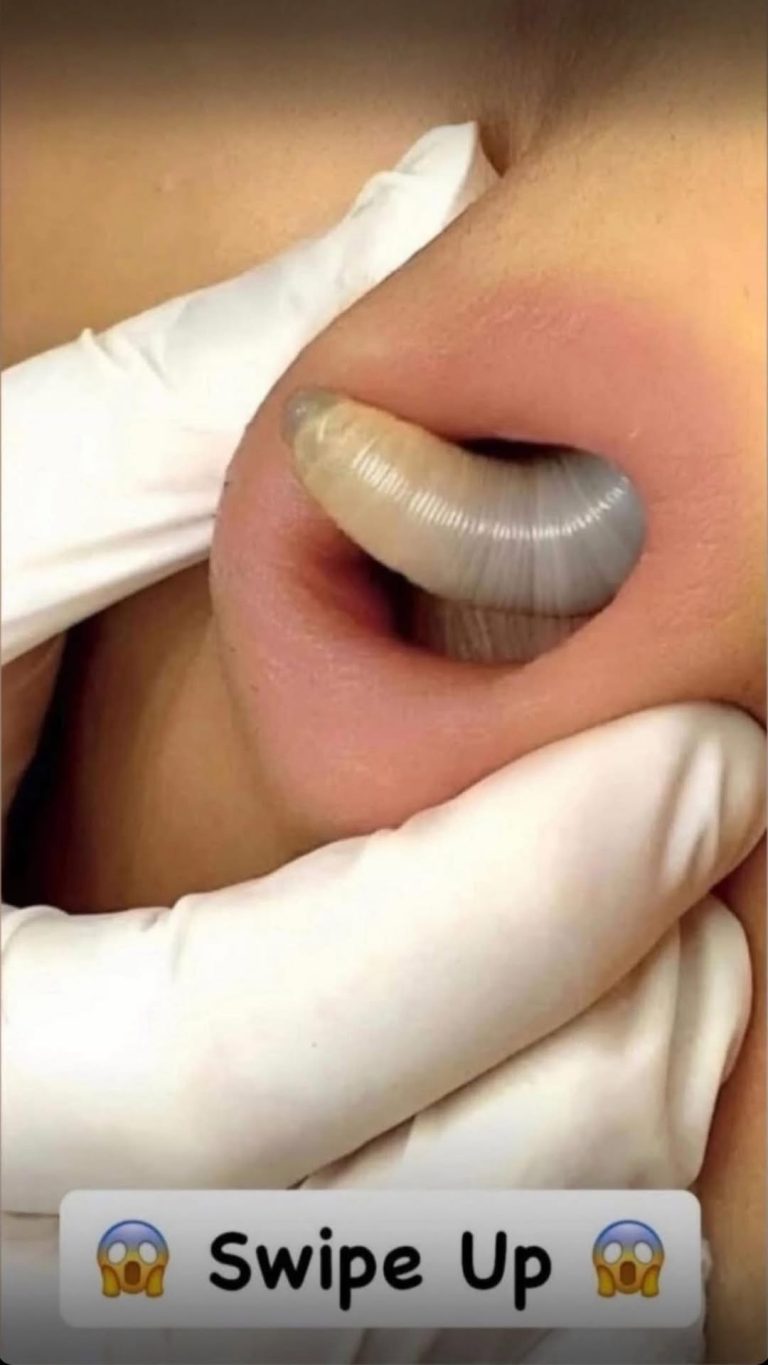 Why You Keep Getting Pimples Inside Your