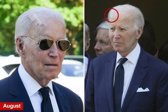 Concerns For Joe Biden As He’s Seen With Shocking Head Wound