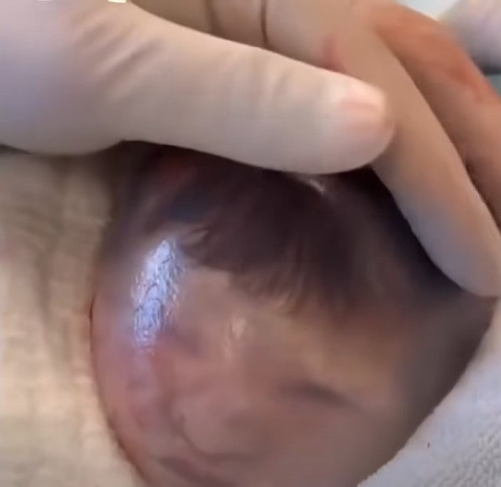 Baby born with an DIU peg… See More