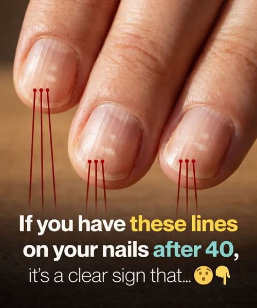 Having Striped Nails Could Mean That Your Body Is… More Details below