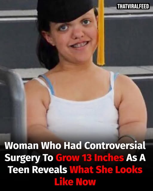 Woman Who Had Controversial Surgery To Grow 13 Inches As A Teen Shows Her Life Now