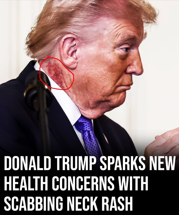 Scabbing neck rash fuels new health speculation around Donald Trump