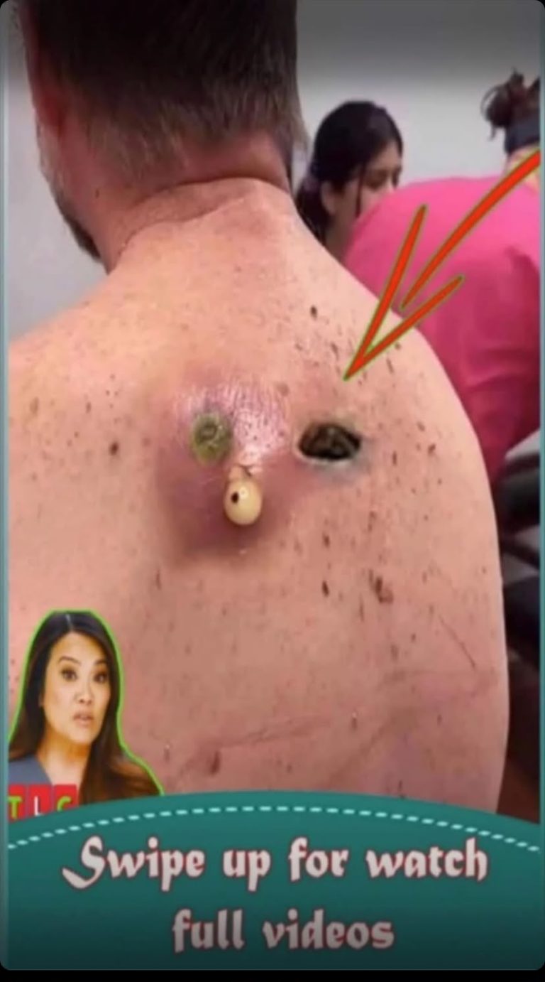 Their acne is severe